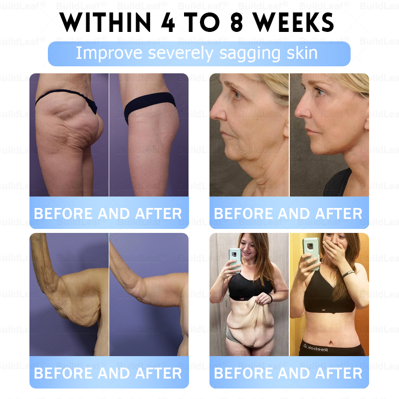 C US 🏥FDA Store |𝐵uil𝗱𝐿ea𝐟® 𝑮𝐋𝑃-1 Slim & Firm 𝑁ano 𝑀icroneedle 𝑃atch with Collagen,Turmeric&Matrixyl 3000 丨Obesity,Cardiovascular Diseas, Diabetes, Sleep Apnea, Joint Problems and More