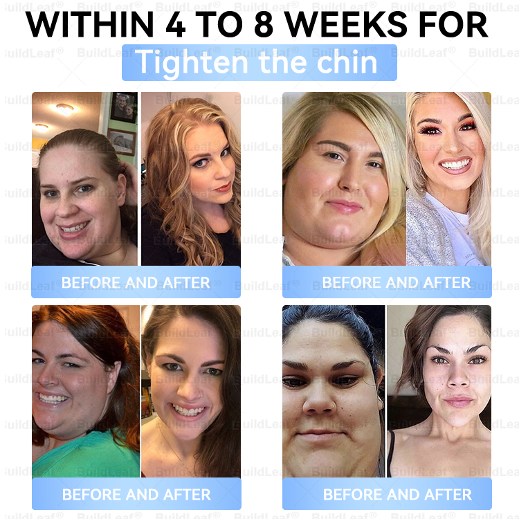 C US 🏥FDA Store |𝐵uil𝗱𝐿ea𝐟® 𝑮𝐋𝑃-1 Slim & Firm 𝑁ano 𝑀icroneedle 𝑃atch with Collagen,Turmeric&Matrixyl 3000 丨Obesity,Cardiovascular Diseas, Diabetes, Sleep Apnea, Joint Problems and More