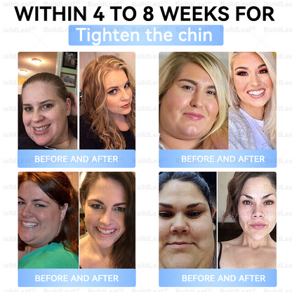 C US 🏥FDA Store |𝐵uil𝗱𝐿ea𝐟® 𝑮𝐋𝑃-1 Slim & Firm 𝑁ano 𝑀icroneedle 𝑃atch with Collagen,Turmeric&Matrixyl 3000 丨Obesity,Cardiovascular Diseas, Diabetes, Sleep Apnea, Joint Problems and More